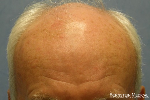 03_before-hair-transplant.jpg