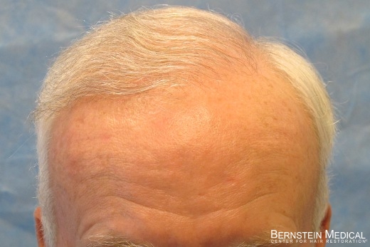 04_after-1st-hair-transplant.jpg