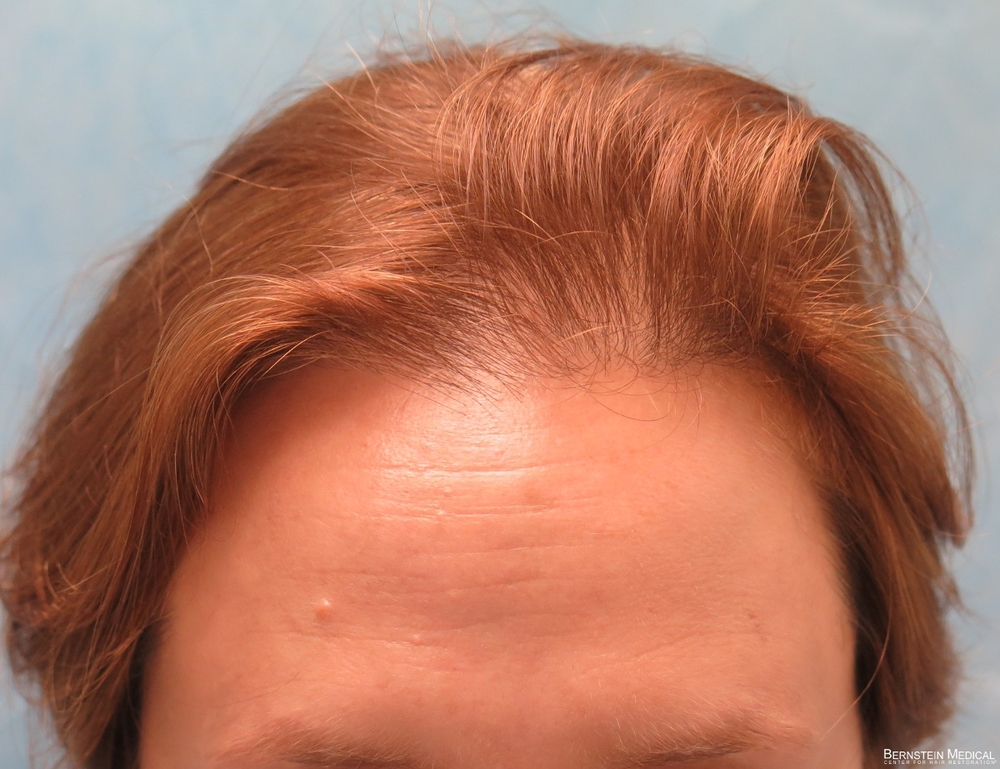 0a_before-hair-transplant_anj.jpg