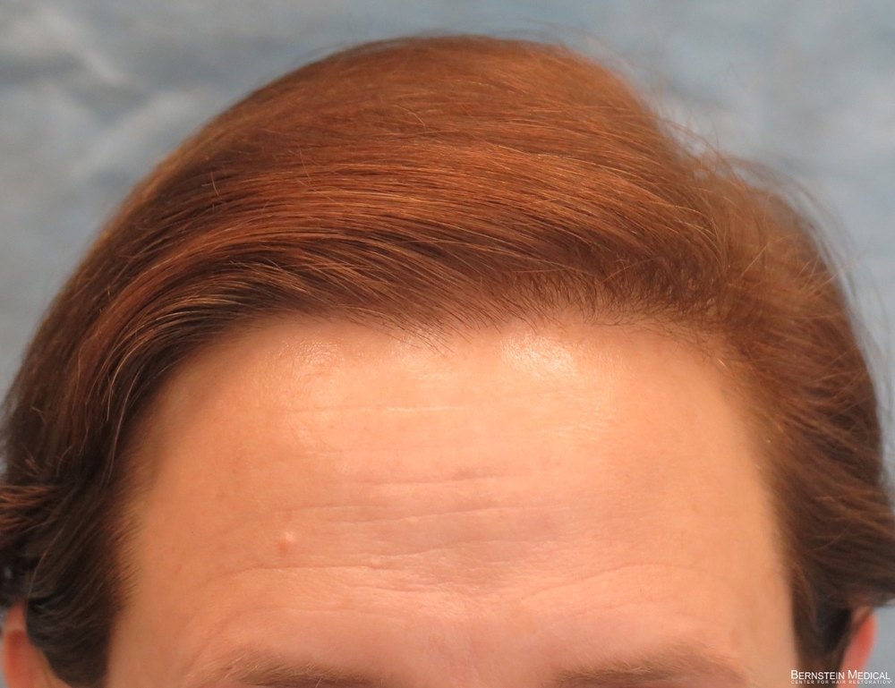 0b_after-hair-transplant_anj.jpg