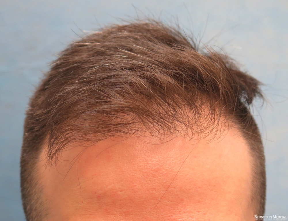 1a_before-hair-transplant_cfq.jpg