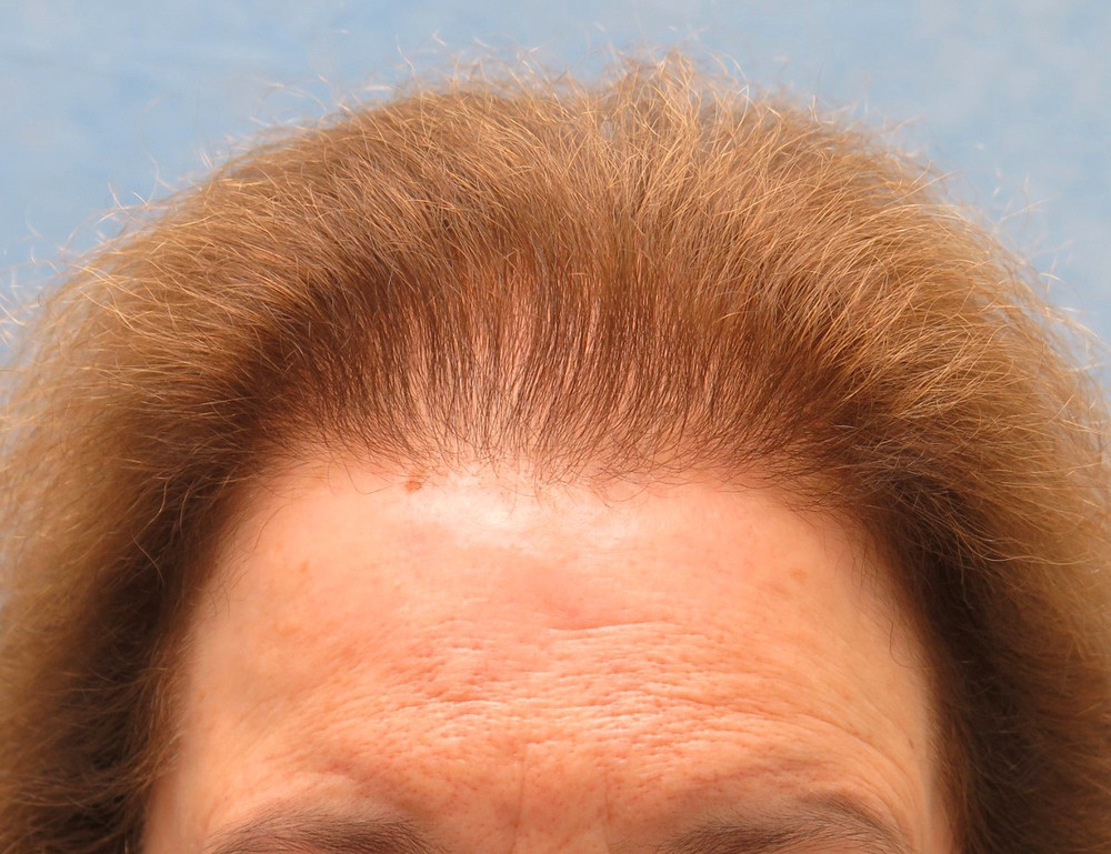 1a_before-hair-transplant_fpk.jpg