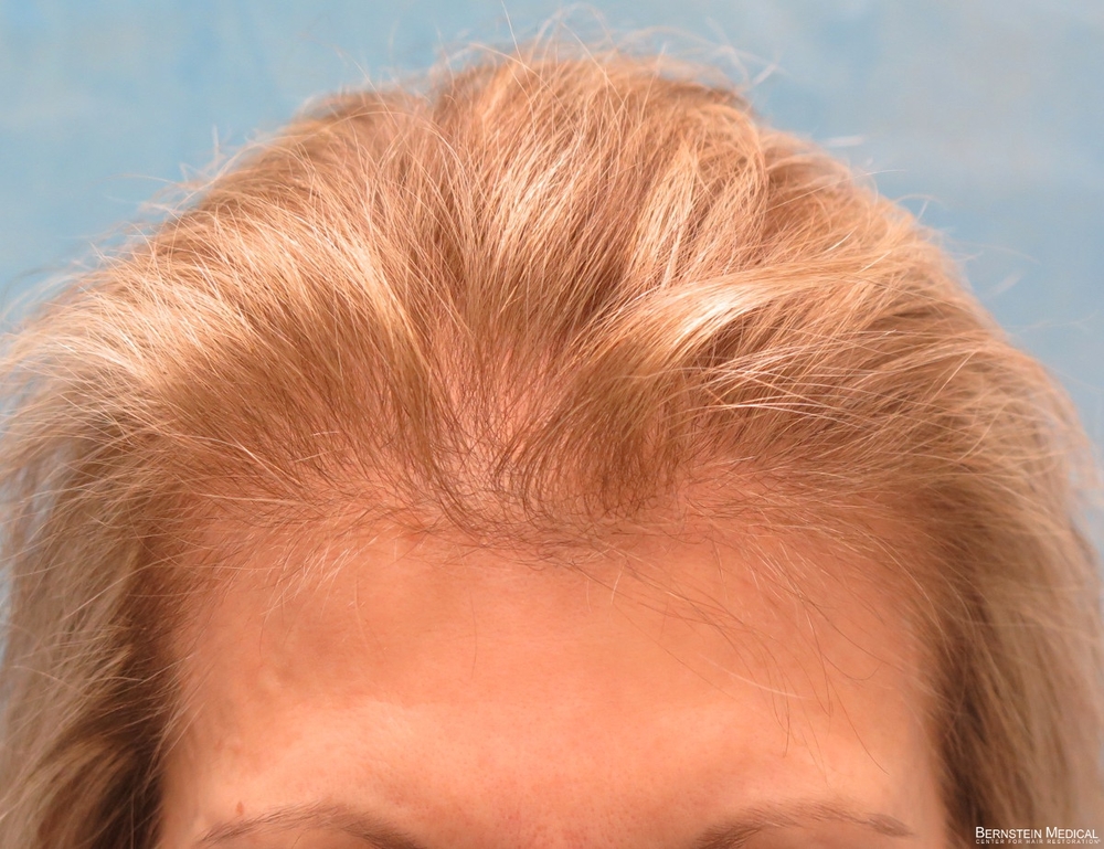 1a_before-hair-transplant_gbe.jpg