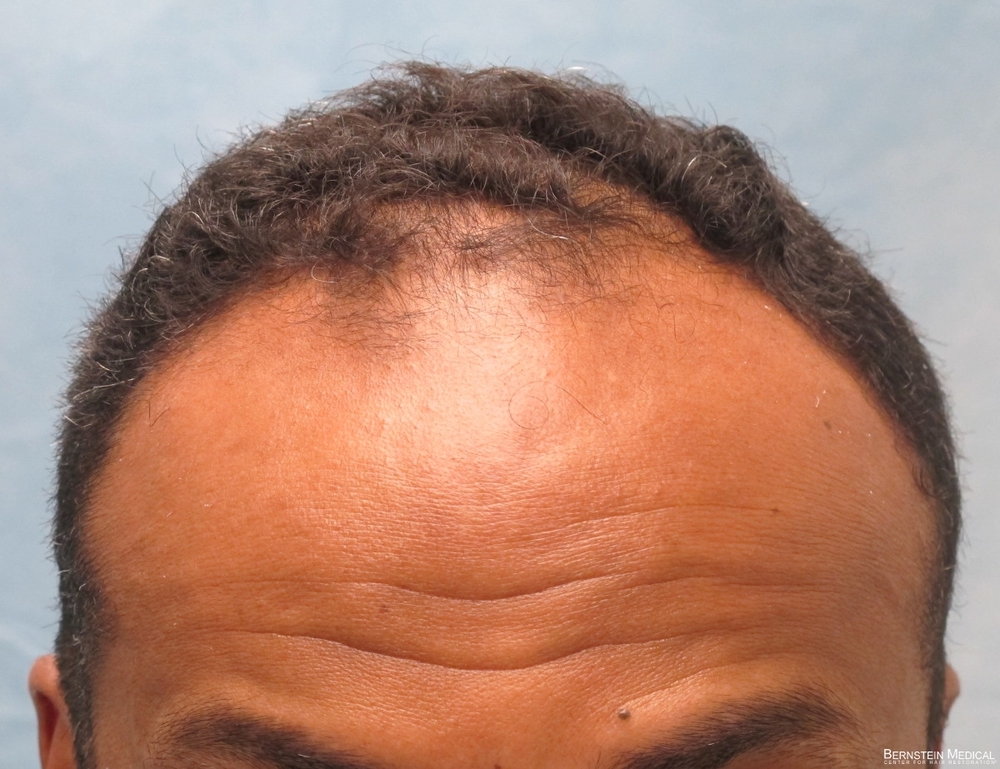 1a_before-hair-transplant_ijc.jpg