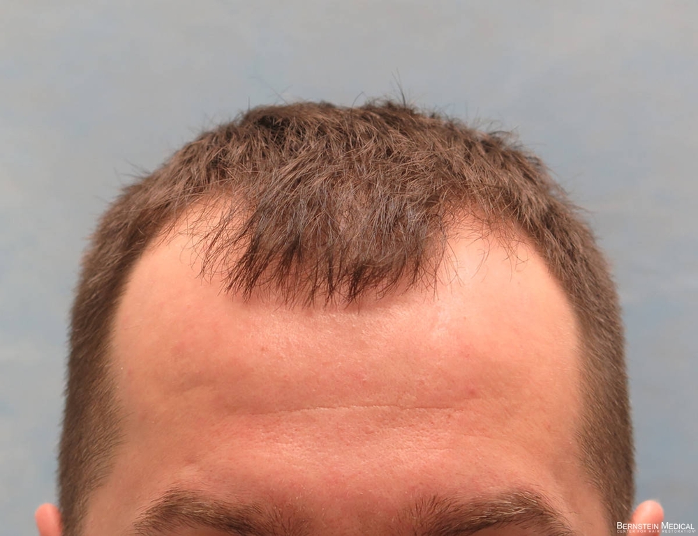 1a_before-hair-transplant_kzk.jpg