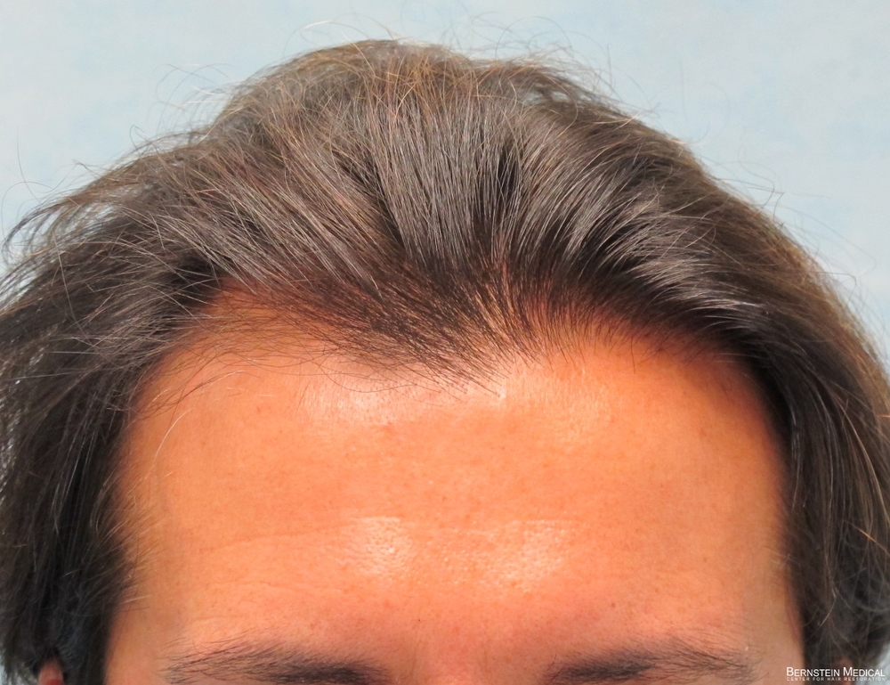 1a_before-hair-transplant_odq.jpg