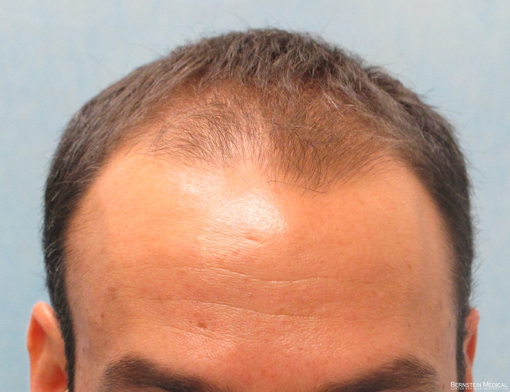 1a_before-transplant_acb.jpg