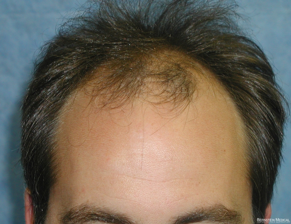 1a_before-transplant_hyc.jpg