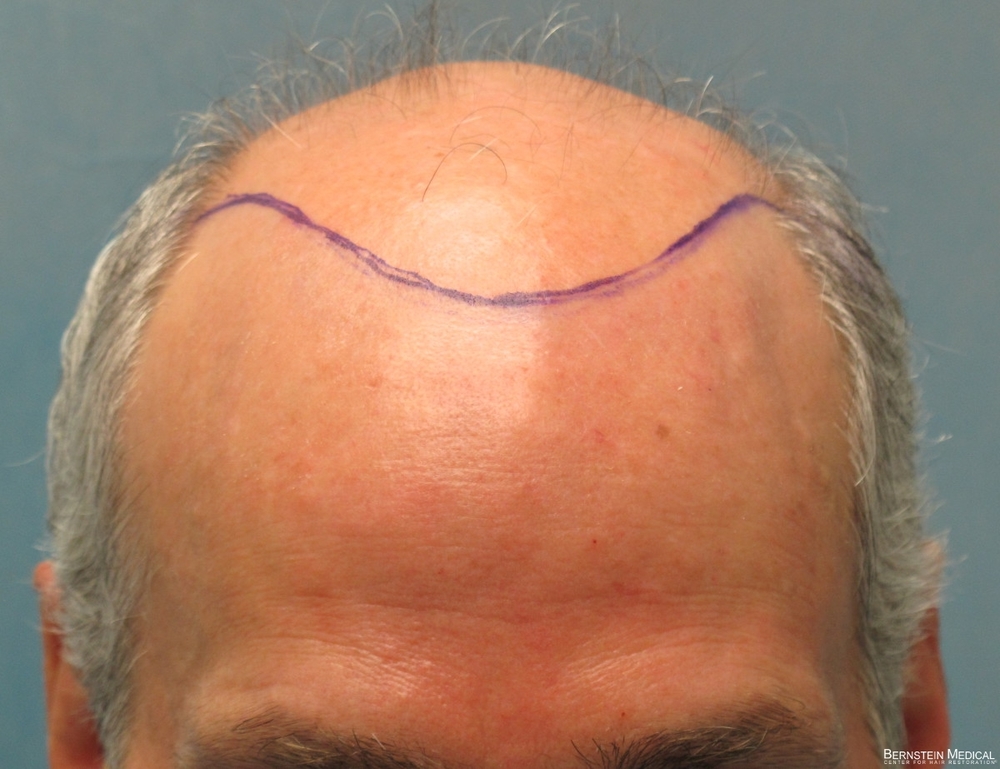 1b-planned-position-of-hairline-avz.jpg