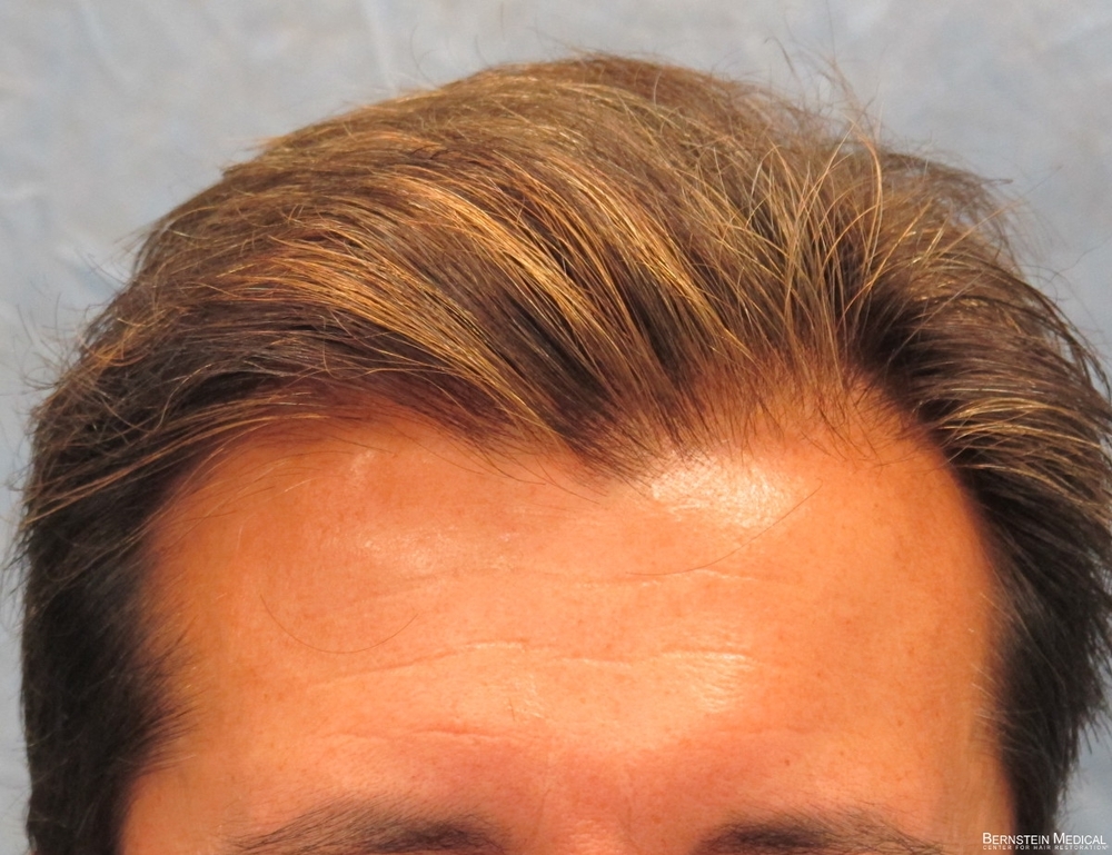 1b_after-hair-transplant_odq.jpg