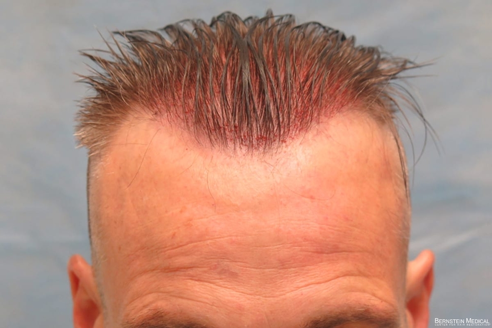 1b_grafts-placed_lki_2s.jpg