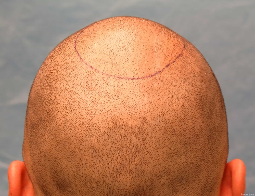 1b_head_shaved_avq.jpg