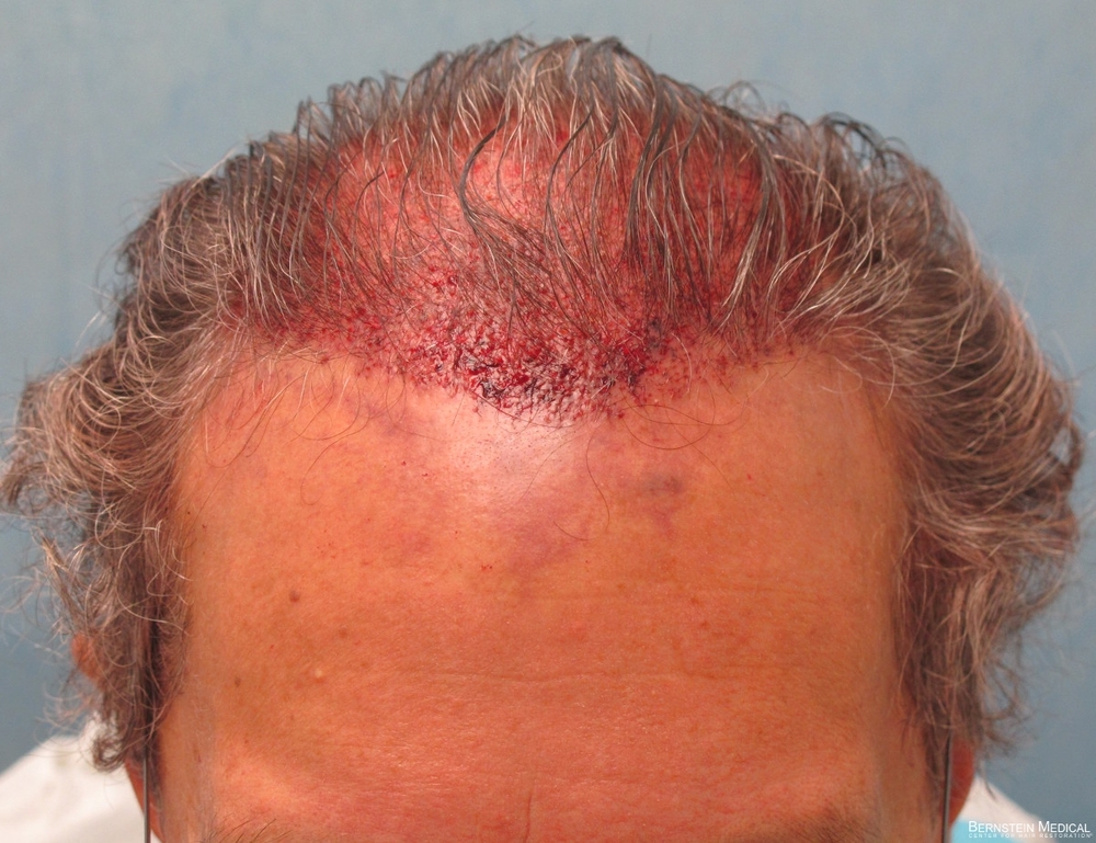 1b_placement-of-grafts_qwe.jpg