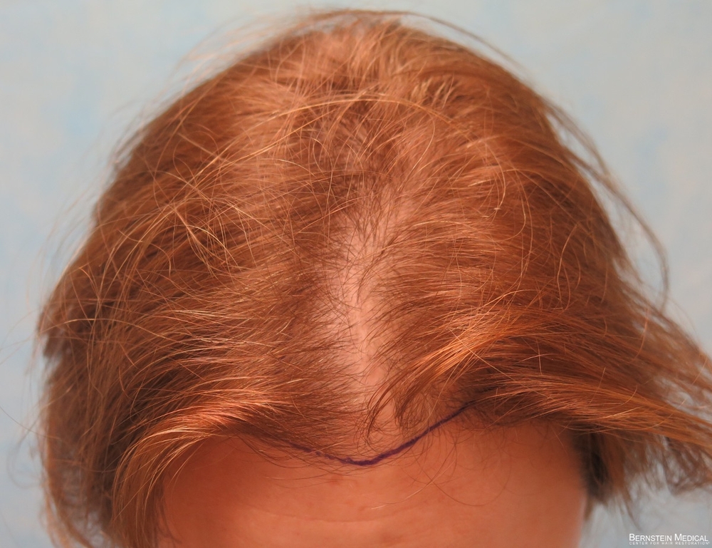 1b_position-of-hairline-top-view_anj.jpg