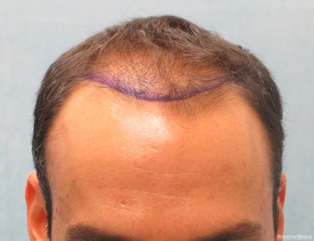 1b_position-of-hairline_acb.jpg