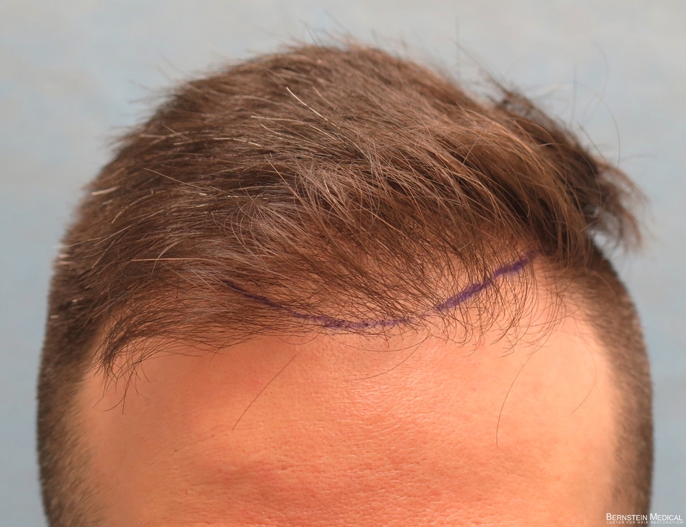 1b_position-of-hairline_cfq.jpg