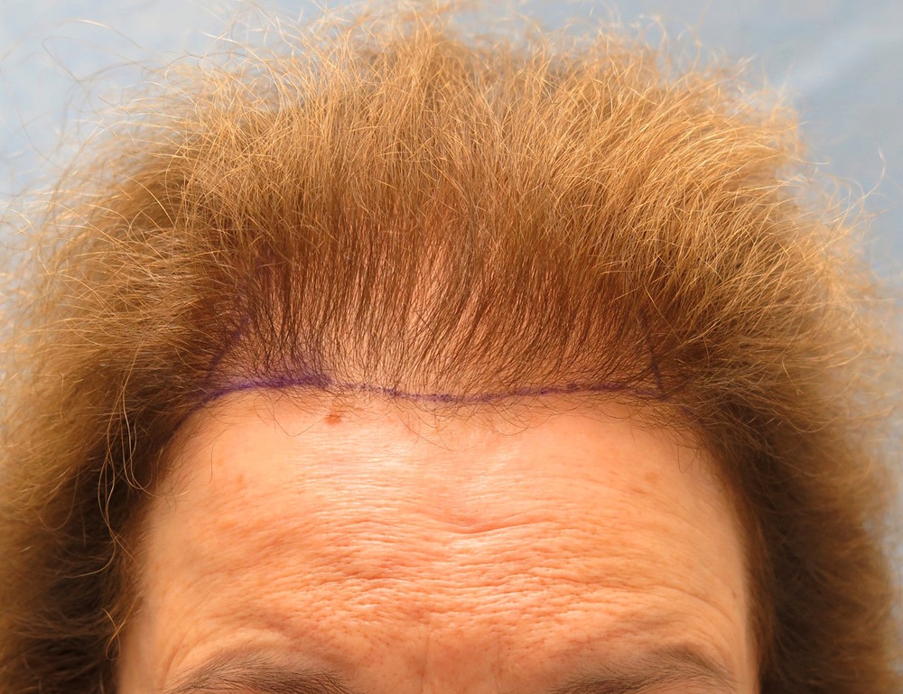 1b_position-of-hairline_fpk.jpg
