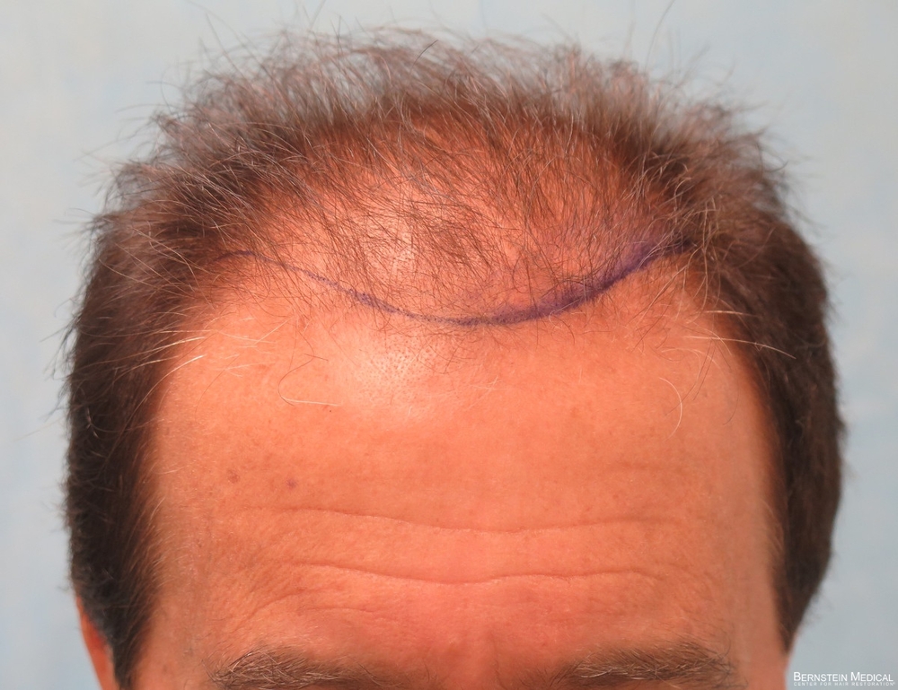 1b_position-of-hairline_hnz.jpg