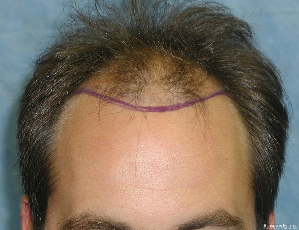 1b_position-of-hairline_hyc.jpg