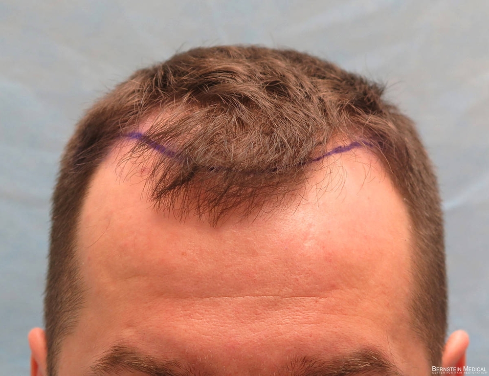 1b_position-of-hairline_kzk.jpg