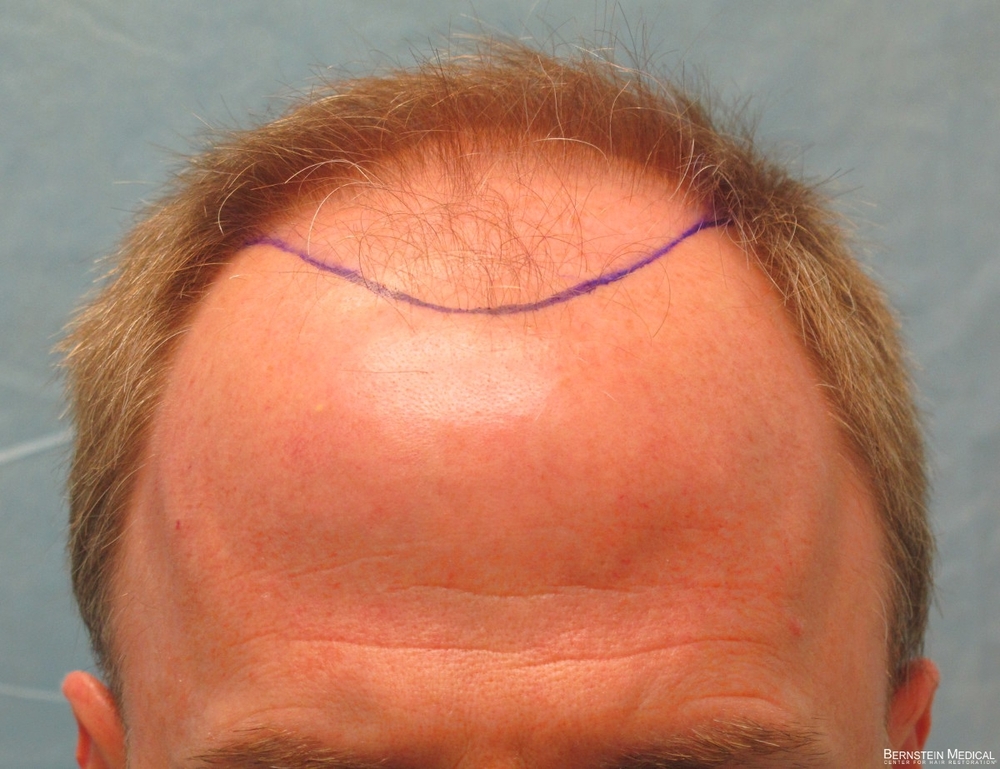 1b_position-of-hairline_rfr.jpg