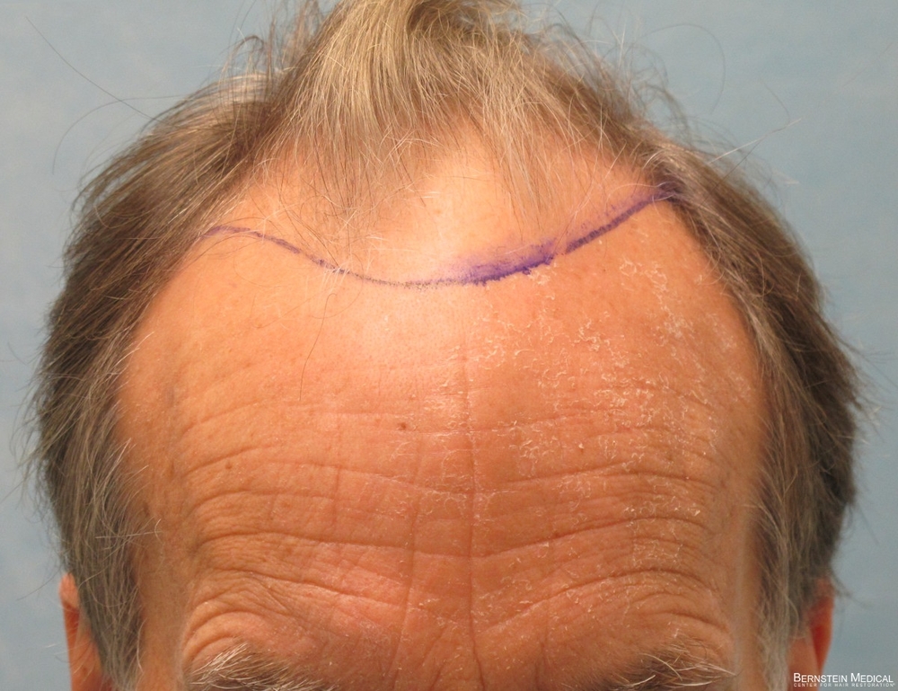 1b_position-of-hairline_rir.jpg