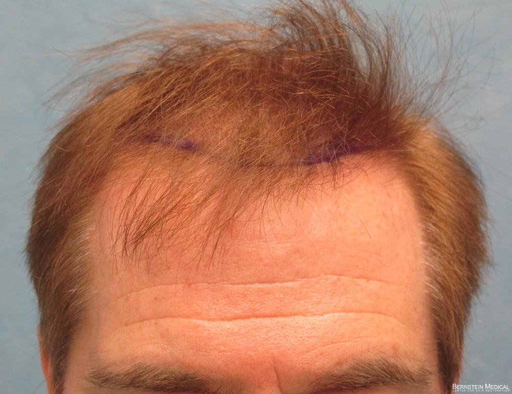 1b_Position_of_planned_hairline_BEO.jpg