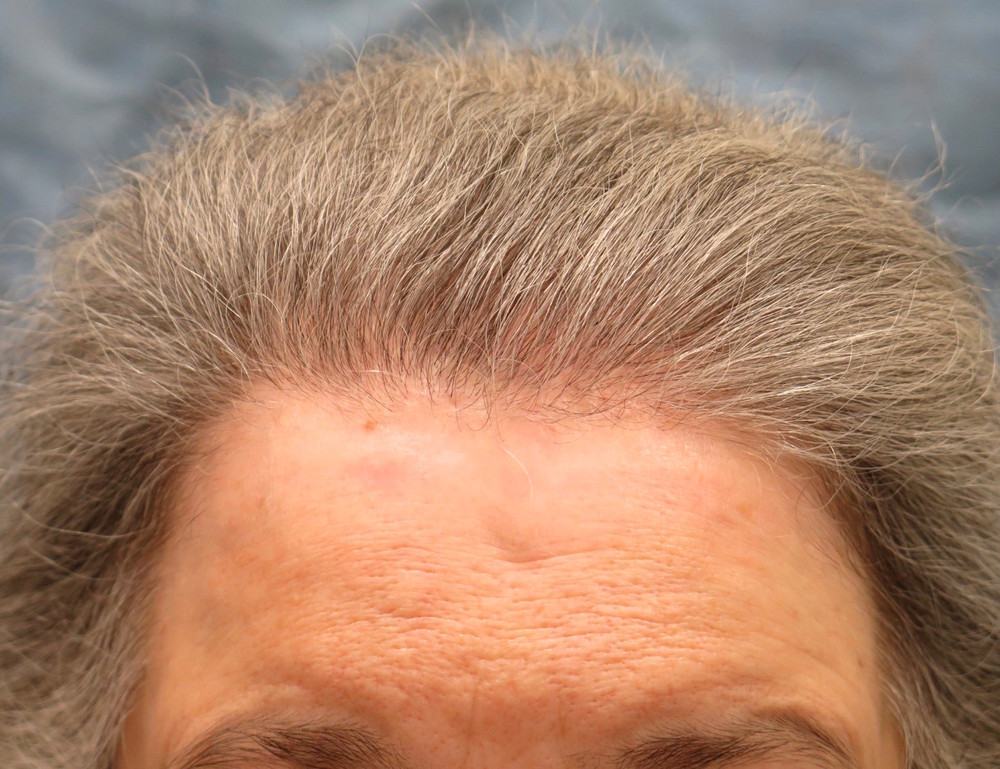 1c_after-hair-transplant_fpk.jpg