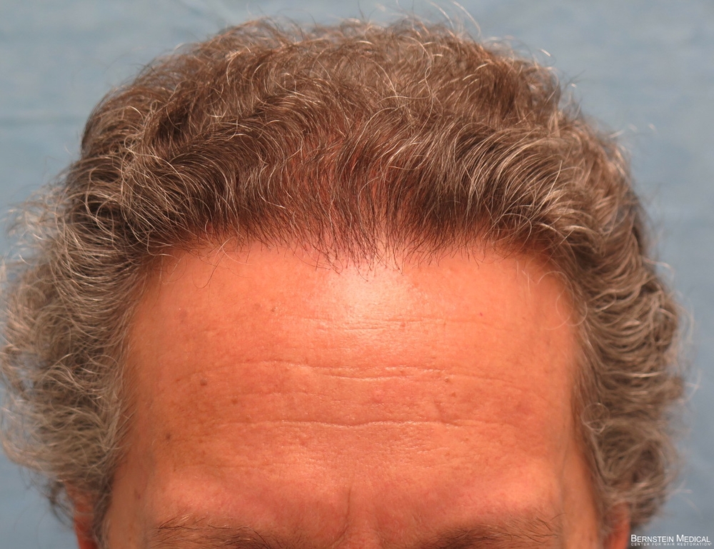 1c_after-hair-transplant_qwe.jpg