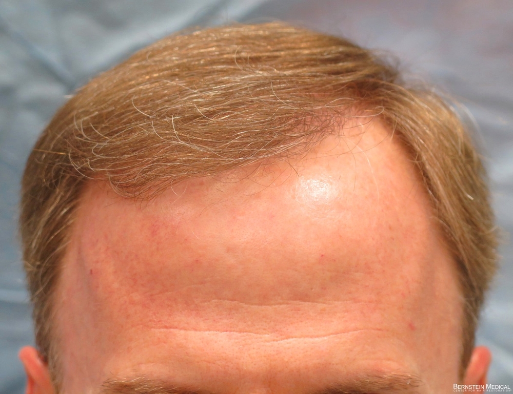 1c_after-hair-transplant_rfr.jpg