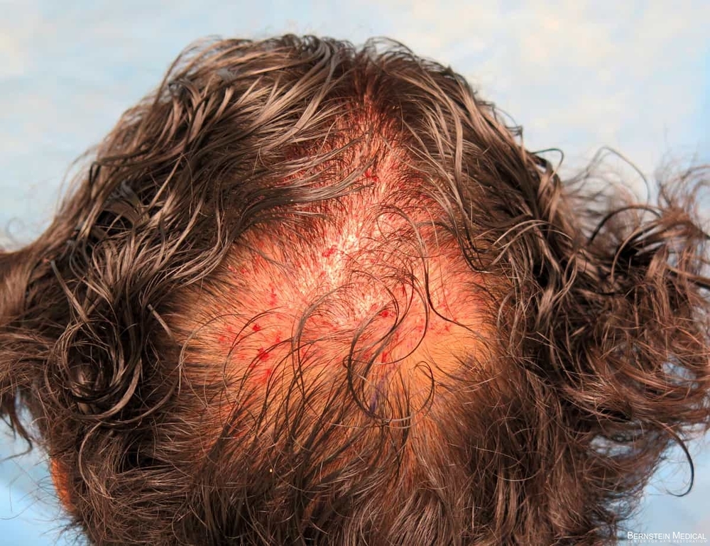 1c_grafts-placed-crown_znq.jpg