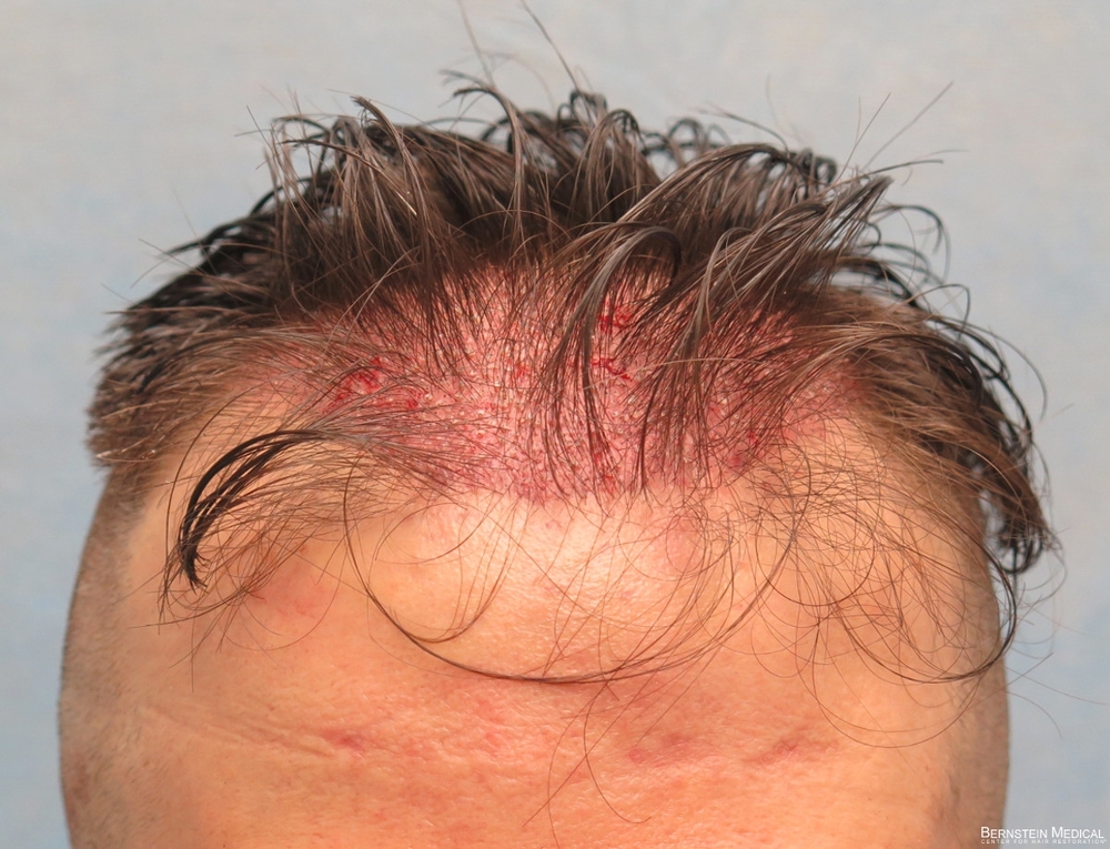 1c_grafts-placed_cfq.jpg