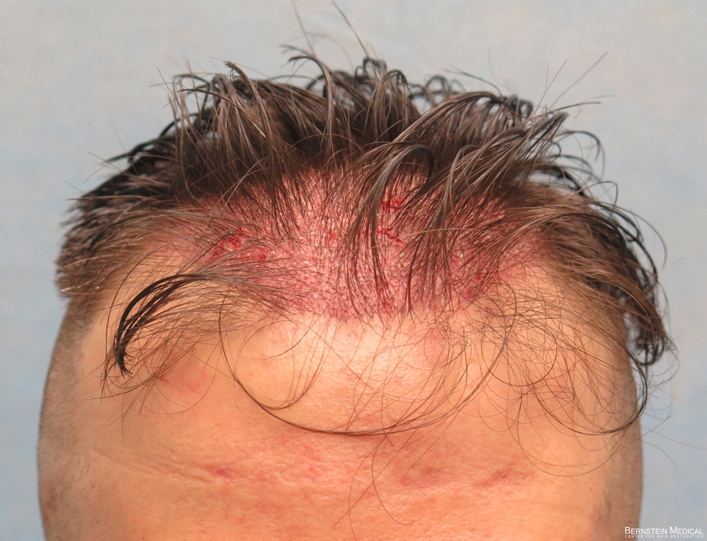 1c_grafts-placed_cfq.jpg