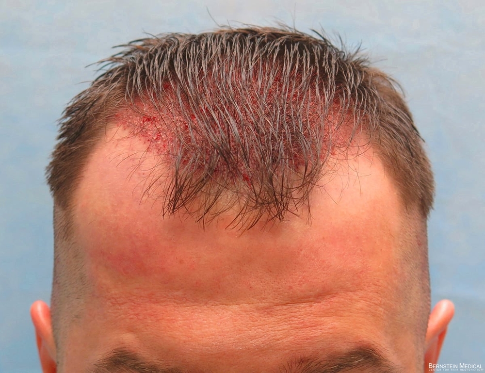 1c_grafts-placed_kzk.jpg