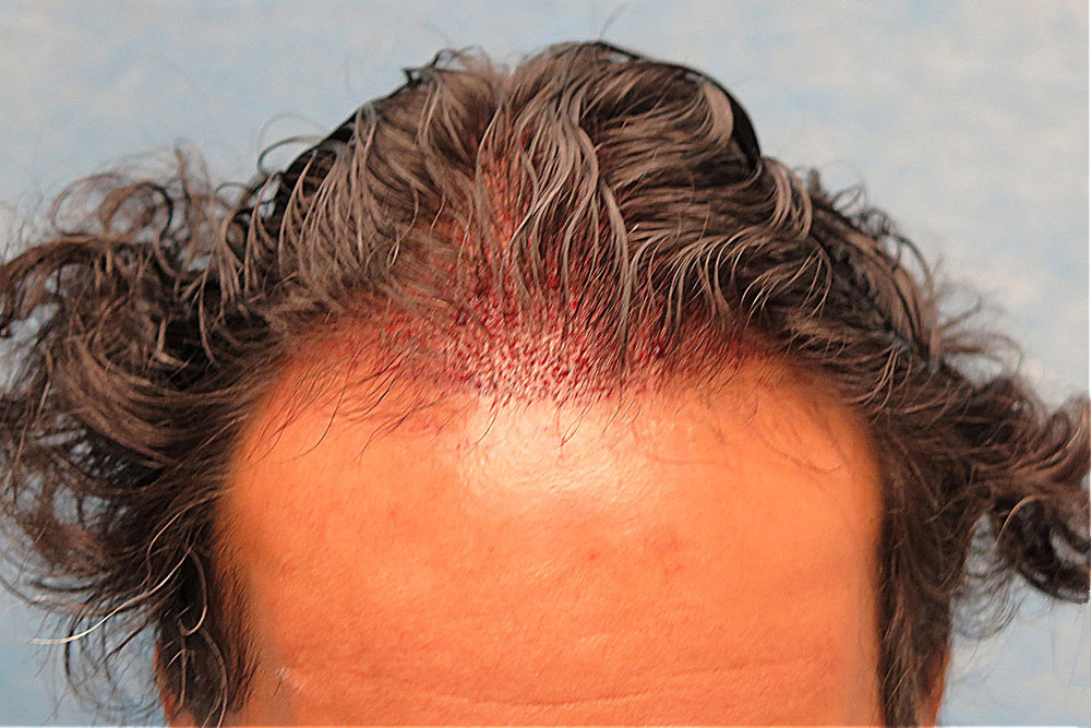 1c_grafts-placed_znq.jpg