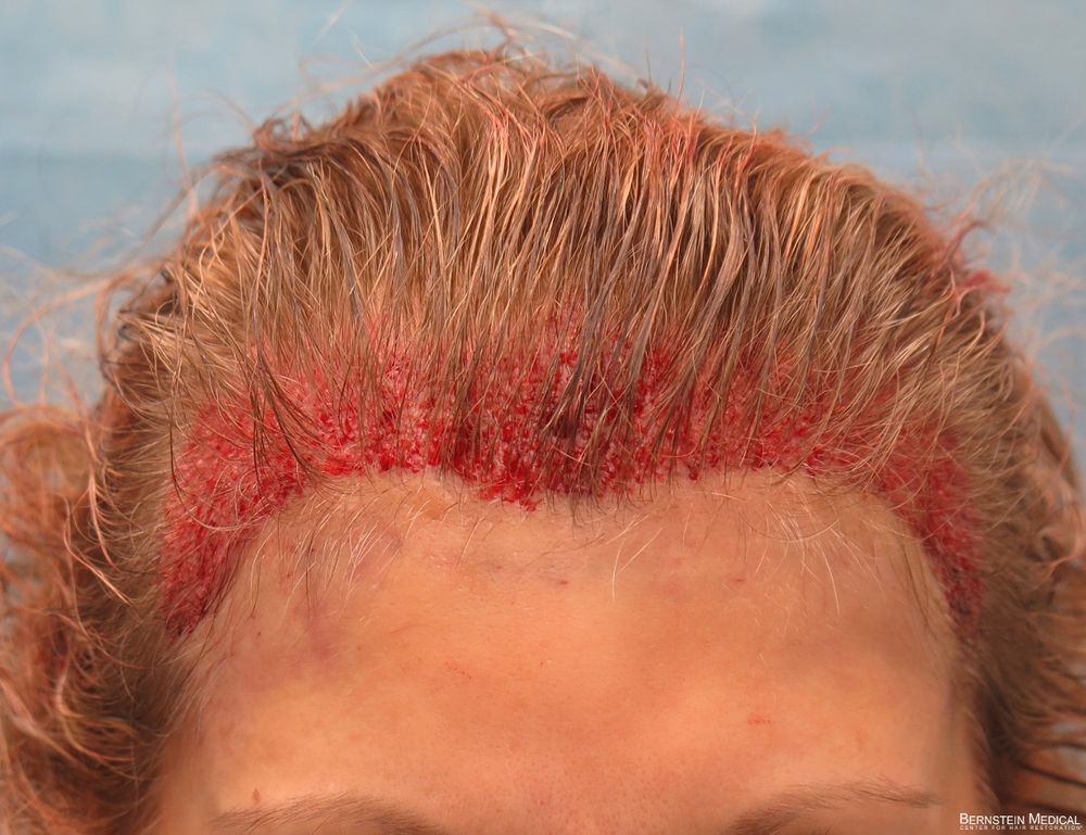 1c_immediately-after-graft-placement_gbe.jpg