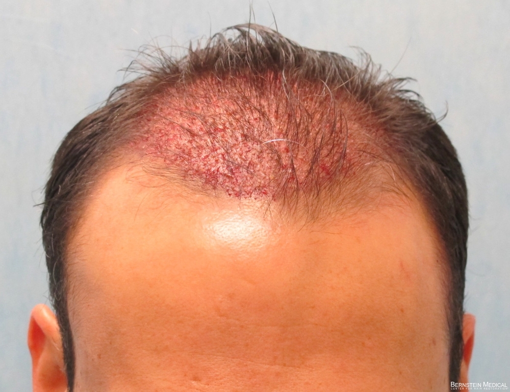 1c_placement-of-grafts_acb.jpg