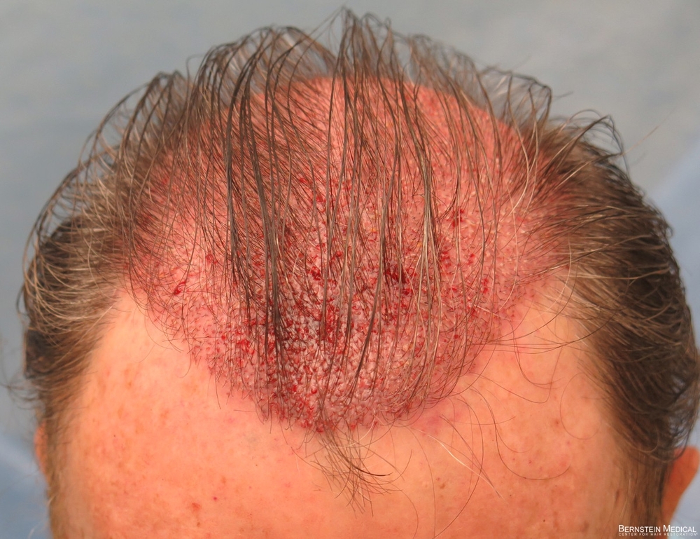 1c_placement-of-grafts_gmz.jpg