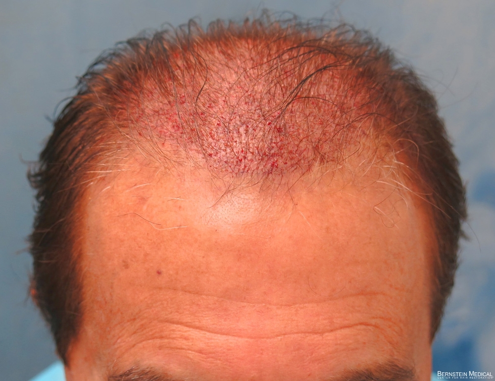 1c_placement-of-grafts_hnz.jpg