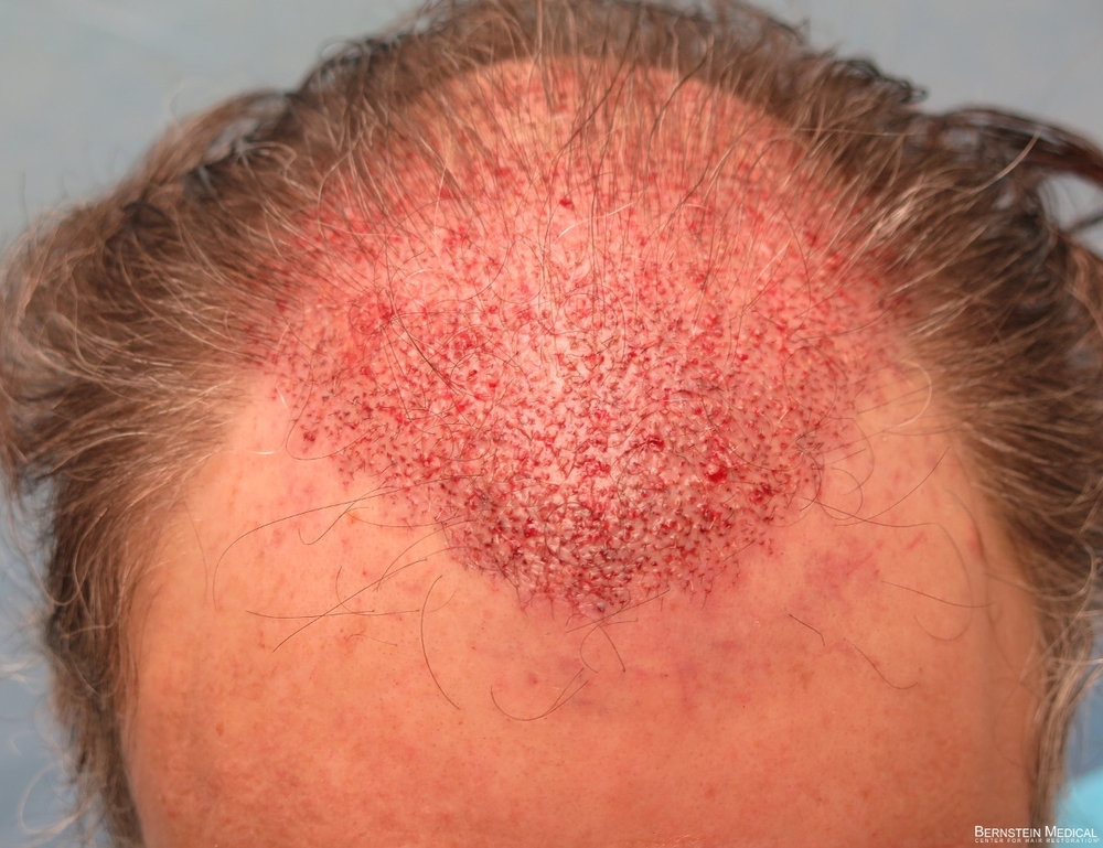 1c_placement-of-grafts_ioi.jpg