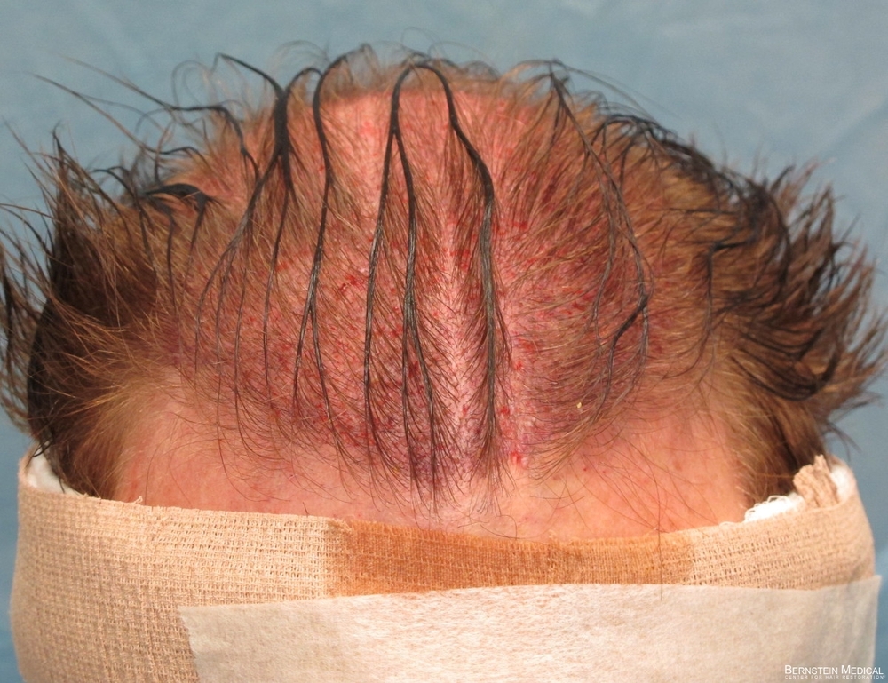 1c_Placement_of_grafts_BEO.jpg
