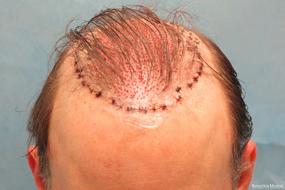 1c_plugs-removed-sutured_eti.jpg