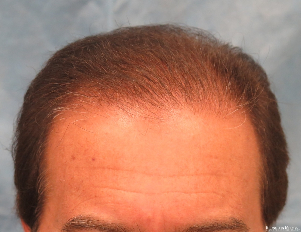 1d_1-year-after-hair-transplant_hnz.jpg