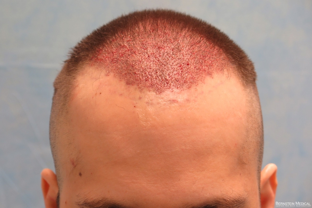 1d_1930-grafts-placed_rsi.jpg