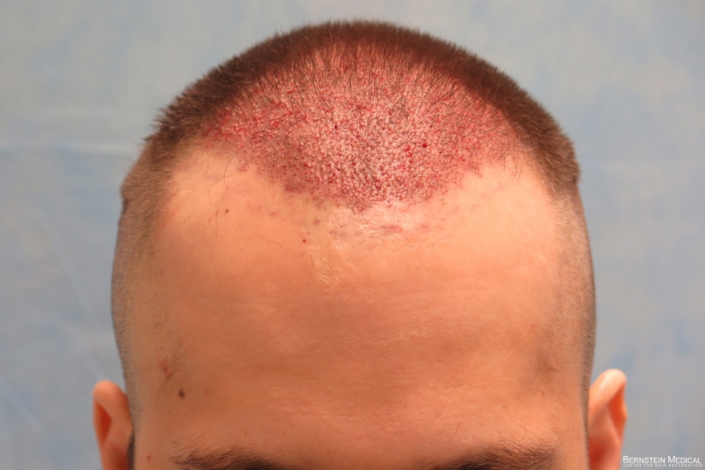 1d_1930-grafts-placed_rsi.jpg