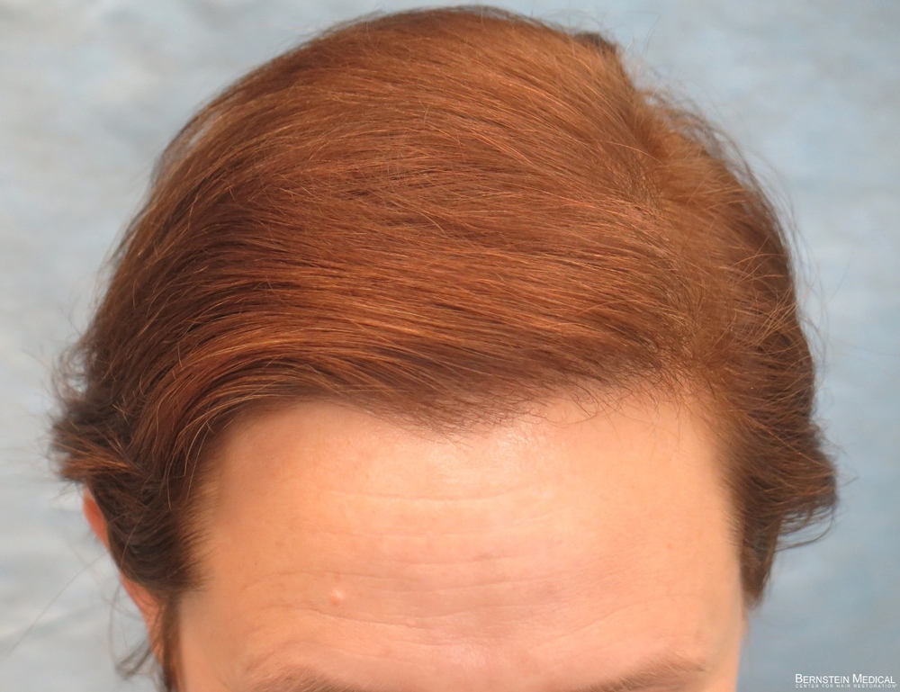 1d_after-hair-transplant-top-view_anj.jpg
