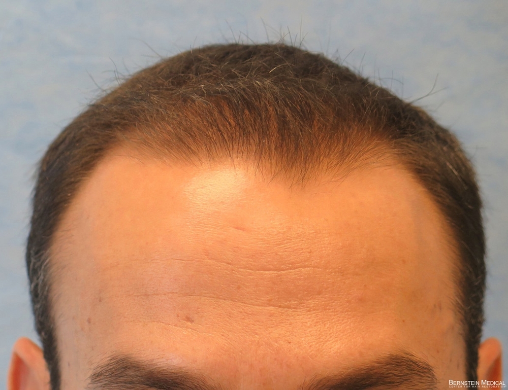 1d_after-hair-transplant_acb.jpg