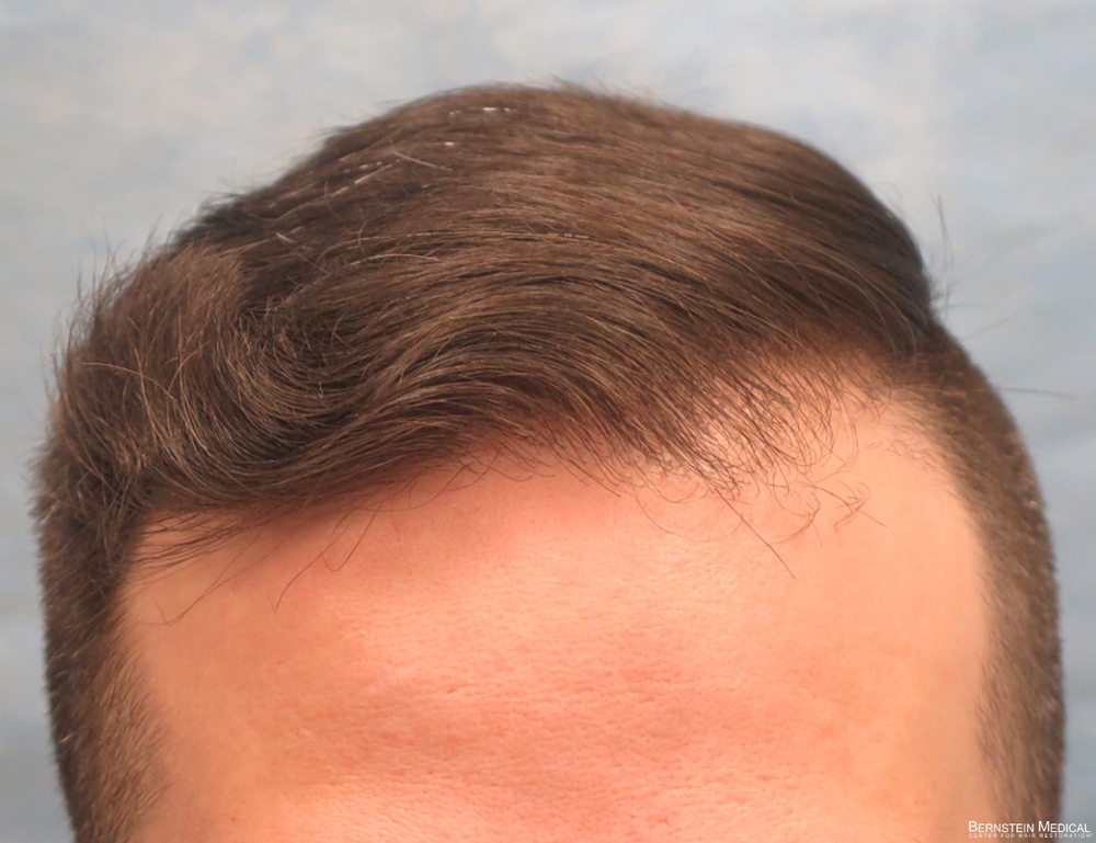 1d_after-hair-transplant_cfq.jpg
