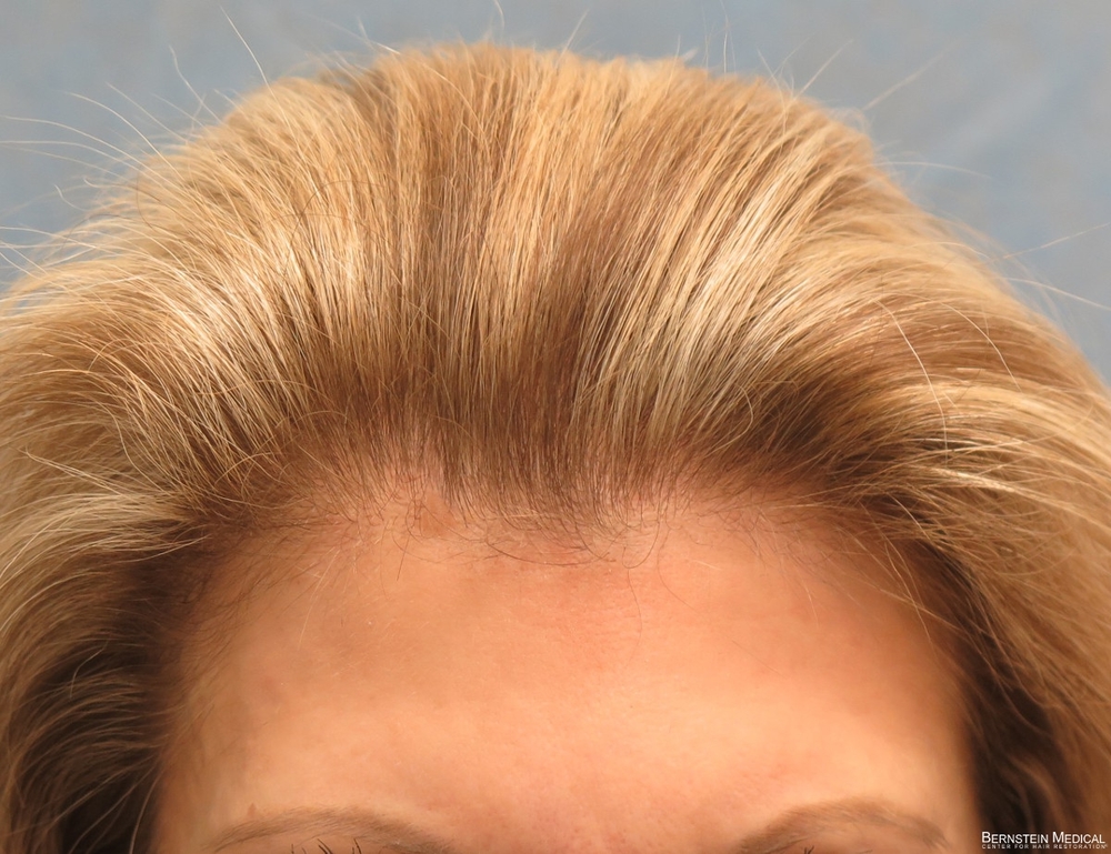 1d_after-hair-transplant_gbe.jpg
