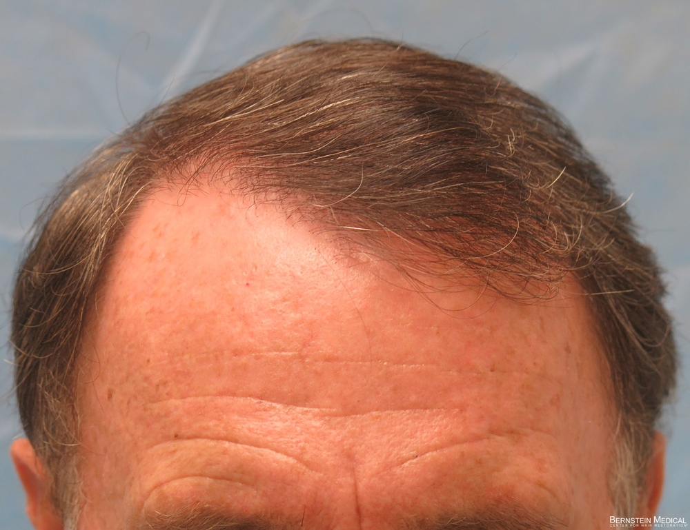 1d_after-hair-transplant_gmz.jpg
